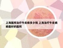 上海医院治疗牛皮癣多少钱 上海治疗牛皮病癣最好的医院