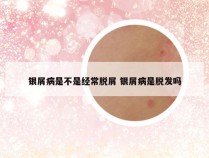 银屑病是不是经常脱屑 银屑病是脱发吗