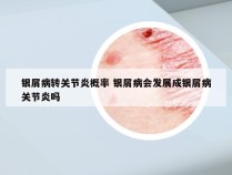 银屑病转关节炎概率 银屑病会发展成银屑病关节炎吗