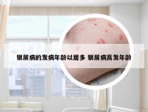 银屑病的发病年龄以居多 银屑病高发年龄