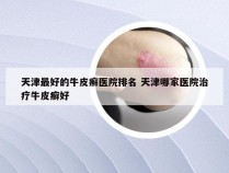 天津最好的牛皮癣医院排名 天津哪家医院治疗牛皮癣好