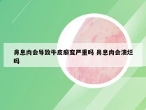 鼻息肉会导致牛皮癣变严重吗 鼻息肉会溃烂吗