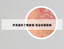 外耳道长了银屑病 耳朵长银屑病