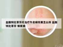 盐酸特比萘芬片治疗牛皮癣效果怎么样 盐酸特比萘芬 银屑病