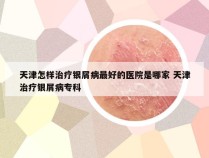 天津怎样治疗银屑病最好的医院是哪家 天津治疗银屑病专科