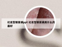 红皮型银屑病ppt 红皮型银屑病用什么药最好