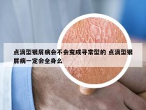 点滴型银屑病会不会变成寻常型的 点滴型银屑病一定会全身么