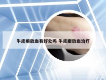 牛皮癣放血有好处吗 牛皮廨放血治疗