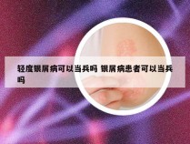轻度银屑病可以当兵吗 银屑病患者可以当兵吗