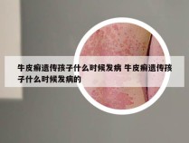 牛皮癣遗传孩子什么时候发病 牛皮癣遗传孩子什么时候发病的