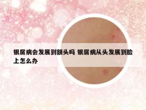 银屑病会发展到额头吗 银屑病从头发展到脸上怎么办