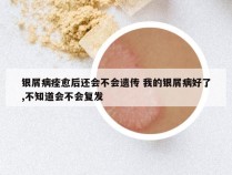 银屑病痊愈后还会不会遗传 我的银屑病好了,不知道会不会复发