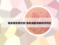 银屑病早期识别 银屑病最初期如何判定
