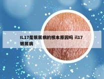 IL17是银屑病的根本原因吗 il17 银屑病