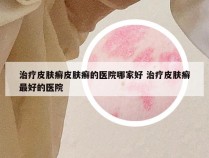 治疗皮肤癣皮肤癣的医院哪家好 治疗皮肤癣最好的医院