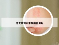 他克莫司治牛皮癣管用吗