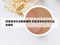 阿昔洛韦片治银屑病吗 阿昔洛韦乳膏可以治皮癣吗