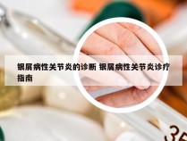 银屑病性关节炎的诊断 银屑病性关节炎诊疗指南