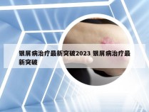 银屑病治疗最新突破2023 银屑病治疗最新突破