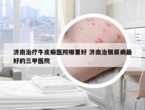 济南治疗牛皮癣医院哪里好 济南治银屑病最好的三甲医院