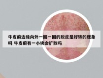 牛皮癣边缘向外一圈一圈的脱皮是好转的现象吗 牛皮癣有一小块会扩散吗
