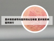 重庆银屑病专科医院地址在哪里 重庆银屑病医院排行