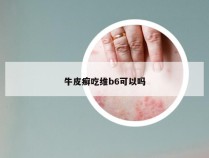 牛皮癣吃维b6可以吗