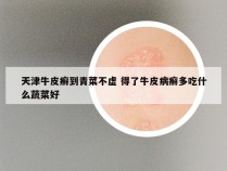 天津牛皮癣到青菜不虚 得了牛皮病癣多吃什么蔬菜好