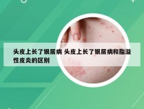 头皮上长了银屑病 头皮上长了银屑病和脂溢性皮炎的区别