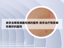 南京治银屑病最权威的医院 南京治疗银屑病效果好的医院