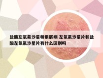 盐酸左氧氟沙星和银屑病 左氧氟沙星片和盐酸左氧氟沙星片有什么区别吗