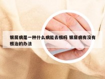 银屑病是一种什么病能去根吗 银屑病有没有根治的办法