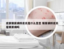 皮肤银屑病样皮炎是什么意思 银屑病样皮炎是银屑病吗
