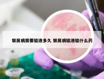 银屑病需要输液多久 银屑病输液输什么药