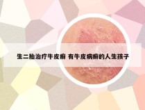 生二胎治疗牛皮癣 有牛皮病癣的人生孩子