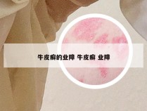 牛皮癣的业障 牛皮癣 业障