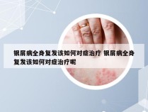 银屑病全身复发该如何对症治疗 银屑病全身复发该如何对症治疗呢