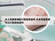头上有银屑病能打新冠疫苗吗 头皮有银屑病可以打新冠疫苗吗