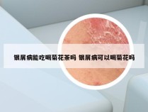 银屑病能吃喝菊花茶吗 银屑病可以喝菊花吗