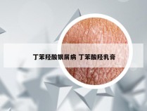 丁苯羟酸银屑病 丁苯酸羟乳膏
