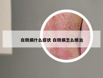 白斑病什么症状 白斑病怎么根治