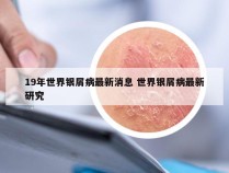 19年世界银屑病最新消息 世界银屑病最新研究