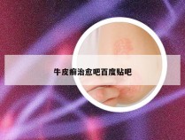 牛皮癣治愈吧百度贴吧