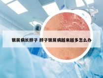银屑病长脖子 脖子银屑病越来越多怎么办