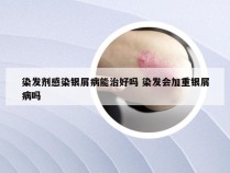 染发剂感染银屑病能治好吗 染发会加重银屑病吗