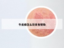 牛皮癣怎么饮食有帮助