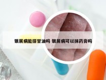 银屑病能搽甘油吗 银屑病可以抹药膏吗