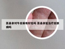 蒸桑拿对牛皮癣有好处吗 蒸桑拿能治疗皮肤病吗