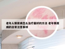 老年人银屑病怎么治疗最好的方法 老年银屑病的日常注意事项
