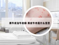 黑牛皮治牛皮癣 黑皮牛也是什么意思